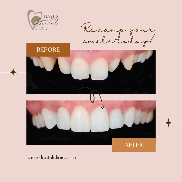 A before and after picture of a smile makeover