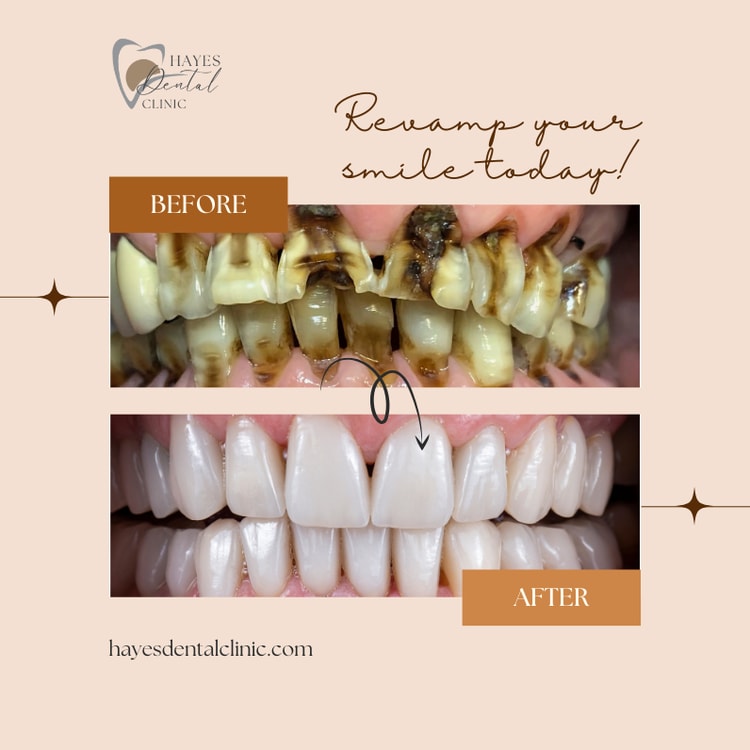 A before and after picture of a smile makeover
